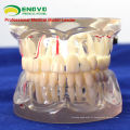 DENTAL07 (12566) modèle pathologique transparent adulte de dents pour l&#39;étude et la communication dentaires
